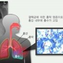 늑막염 증상 및 원인 치료 이미지