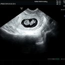 풍진푸드 | [난임일기/임신일기] 마마파파앤베이비 동결이식 1차 / 임신 6-8주차 일상 / 풍진양성?!