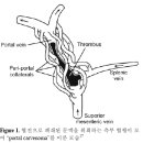 문맥 혈전증 이미지