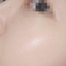 지브로홍대 | 홍대입구역피부과 포텐자기본팁 스킨부스터 모공관리 2회차