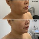 [청주] 슈퍼 파워 리프팅 사창동 피부뷰티샵 온담에스테틱 내돈내산 후기