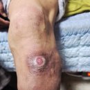 참의수족보조기 이미지