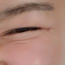 프리미엘의원 | 프리미엘의원 광화문점 튠페이스 리프팅 후기