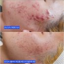 탄방메디칼 | 피부가 칙칙하다면? 각질주기부터 점검하세요