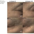 리즈힐의원 | 리즈네 효과 수치로 확인해 본다면?