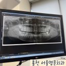 홍천 서울명문치과 사랑니 발치 후기