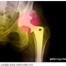 골반!! 피가 원활히돌지못하여 유명한야구선수 김재현 ㅠㅠ 혈액공급이중단된대퇴골"괴사증" 산소와혈액의중요성 이미지