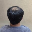 원호암5길 | 충주 부분 가발 시술 하는곳 추천 후기 (두피미학본점)