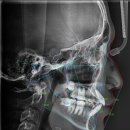 동재치과의원 | 치아 겹침 있는데 꼭 발치해야 할까? (비발치 교정 후기)