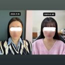 하일리의원 | [내돈내산] 옆광대, 사각턱 심한 땅콩형 얼굴 하일리의원 하이컷주사 2회차 시술 전후 비교