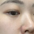 리뉴한의원 | [서면 모공 축소] 서면 실펌 엑스 모공리뉴테라피 7번째 후기 !!