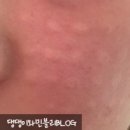 사계절예쁨의원 | 예쁨주의쁨의원 천안점에서 스킨 부스터 필로드 2cc 솔직 후기