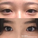 양진일원장 | [강남언니] 쌍꺼풀 수술(쌍수) 앞트임하면 안 되는 케이스부터 재수술 성공하는 법까지!(feat. 성형외과...