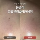 단에스테틱&아카데미 | 김포 모공관리 잘하는 윤슬아 토탈뷰티&아카데미 천방케어 300샷 후기