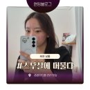 부천 상동 피부과 좁쌀 여드름 압출 잘하는 곳 스무살에 머물다
