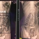 '변비' 때문에 17일 동안 화장실 못 간 여성의 충격적인 엑스레이 사진 이미지