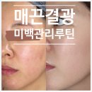 펄스킨케어 | 멜라펄 토닝팩 5일 후기 기미케어 홈케어 루틴 솔직리뷰