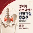 엉치 통증 불러오는 천장관절증후군 원인과 골반 균형 관리법