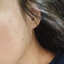 방배동 메리트피부과 : 편평사마귀 레이저 치료 후기