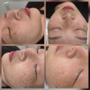 명품앤뷰티 | 미작뷰티인천 제로스팟 클리어스팟 주근깨 완전 제거 후기