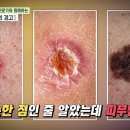 [닥터의 경고, 노인 피부질환] 동안 피부 유지 비법부터 피부 질환의 위험성까지 노인성 피부 질환에 대해... 이미지