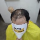원자력병원 버스정류장 | 남자당일착용가발 급하게 필요한 분들을 위한 현실해결책