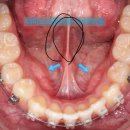 나 우짜노..여기에 구내염생김 이미지