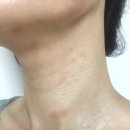 시행착오 | 알약 유산균 아토피 피부 자생 면역 1년 시행착오 후기