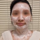 삼성의원 | 김포삼성의원 편평사마귀 레이저 리터치 후기