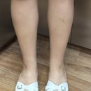 엘리트치과의원 | 수지구청피부과 레이저제모 종아리 후기 젠틀맥스 프로 플러스