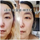 엑쎄라피 HIFU 써클샷으로 처진탄력잡기 1주차