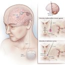 파킨슨 수술요법 뇌심부자극술(DBS) 이미지