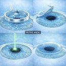 삼가-28 | 👀 고도근시+난시 라섹 수술 한 달 후기 (시력, 수술, 통증, 회복)