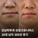 유니커스 | 강남피부과 20대 남자 슈링크 유니버스 300샷 후기 통증 효과 비교