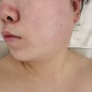도솔한방병원 | [평택/소사벌] 평택 피부관리 추천, 민감성 피부도 편안했던 뜰에스테틱 본점 하이푸 리프팅 후기
