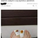 약혐) 내성발톱 쉽고 간단하게(?) 치료 후기 ㄷㄷ 이미지