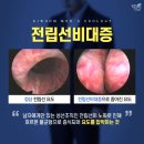 유로합동비뇨기과의원 | 전립선비대증 수술방법, 절개 없이 가능한 치료법이 있다면?