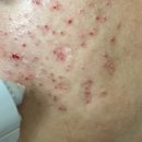 하나의료조합 영흥우리의원 | 울트라펄스알파 여드름흉터 1000명 돌파! 피부과전문의 후기 &amp; 추천복합치료(미라젯·쥬베룩)