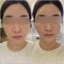 생각나는한의원 | 수성구리프팅 티나는한의원 EM피어리 관리로 중안부 리프팅 솔직후기