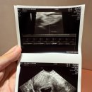 세민약국 | 임신 초기 7주차부터 10주까지 증상 (초기출혈, 난임병원 졸업)