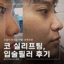 케이톡스의원 인천구월점 | 뭉툭한 코끝+비대칭 입술? 인천피부과 코 실리프팅&amp;입술필러 전후 대박! 생생한 후기 1탄