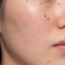 맑은솔약국 | 점뺀후 재생크림 흉터 흔적 1도 없이 새살 솔솔 돋는 방법