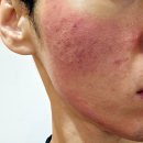 오름한의원 | 홍대피부과 추천｜여드름자국 및 흉터제거 전문 홍대한의원 오름테라피 3회차 솔직후기