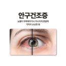 거상글로벌 | Eye 아이 세르프 효과 후기 -베르니포레의원