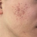 안성맞춤한의원 | 구로구 피부과 한의원 여드름 패인흉터 제거 새살침 치료 2회차 찐 후기