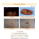 담낭용종수술후기. 올해 정기건강검진 시에 용종의 크기가 12mm정도 된다고 하여 수술을 하는 것이 좋다고 하였습니다. 이미지