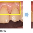 잇몸내려앉음 이가시린이유 충치 이시림 시린이 치료 이미지