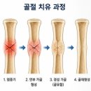 안성자연한의원 | 골절은 언제 붙을까요? 부위별 평균 유합기간 총정리 (안성한의원)