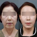 70대안면거상, 지금 해도 늦지 않을까요? 실제 변화 기준으로 설명드립니다
