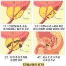 전립선암 검사를 받아보셔요 이미지